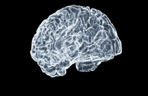 CT imaging reveals more than a third of ‘old strokes’ are unknown to patients and physicians CT