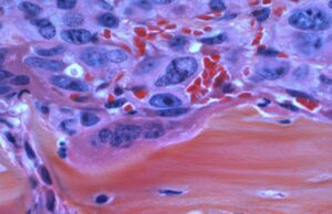 CIREL study finds comparable overall survival between indication for irinotecan-TACE in colorectal liver metastases