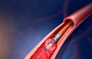 BD to initiate real-world patient registry for Rotarex atherectomy system Rotarex