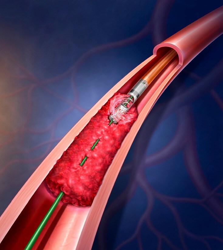 BD to initiate real-world patient registry for Rotarex atherectomy system