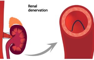 CMS recommends coverage for renal denervation for hypertension