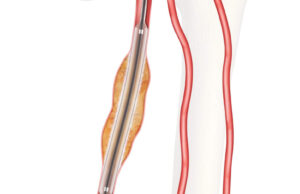 FDA grants approval for IDE study on Advance Evero 18 everolimus-coated balloon catheter