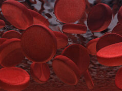 New Medicare analysis shows increased thrombectomy use in venous disease Thrombectomy