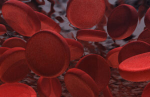 New Medicare analysis shows increased thrombectomy use in venous disease Thrombectomy