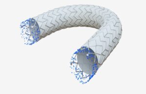Clinical trial of covered stent graft for dialysis access dysfunction completes enrolment