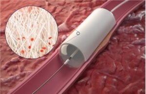 Strutless bioresorbable BTK scaffold demonstrates technical success and primary safety in first cases