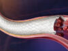 BD receives CE mark for Revello vascular covered stent