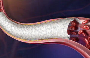 BD receives CE mark for Revello vascular covered stent