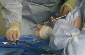 Fluidx Medical announces first patient treated with novel embolic gel