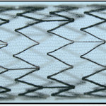 CGUARDIANS II shows positive 30-day outcomes for carotid stent use in TCAR procedures