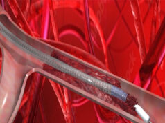 VentiV Scientific completes first-in-human use of V-Pulse mechanical thrombectomy system VentiV Scientific