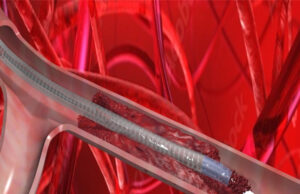 VentiV Scientific completes first-in-human use of V-Pulse mechanical thrombectomy system VentiV Scientific