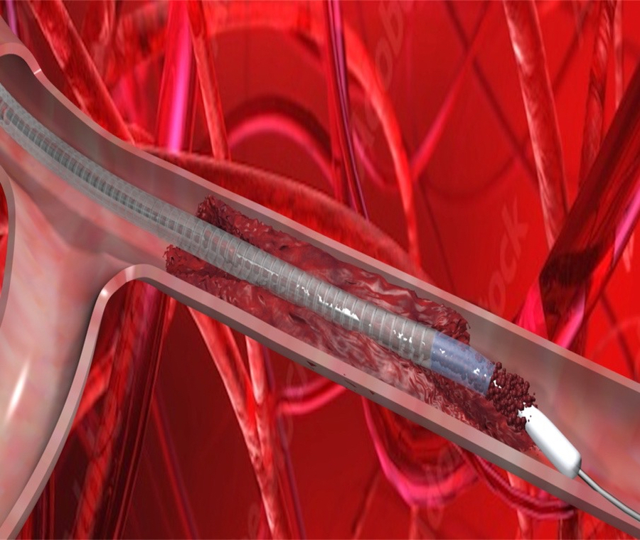 VentiV Scientific completes first-in-human use of V-Pulse mechanical thrombectomy system