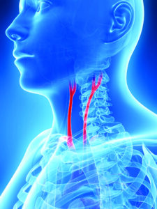 carotid artery stenting