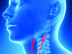 Editorial argues carotid stenting has reached “prime time” following CREST-2 carotid artery stenting CREST-2