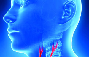 Editorial argues carotid stenting has reached “prime time” following CREST-2 carotid artery stenting CREST-2