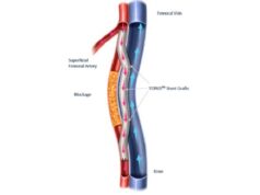 Three-year DETOUR2 results demonstrate sustained limb preservation in complex SFA disease Detour