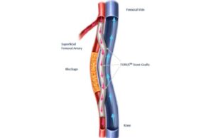 Three-year DETOUR2 results demonstrate sustained limb preservation in complex SFA disease Detour