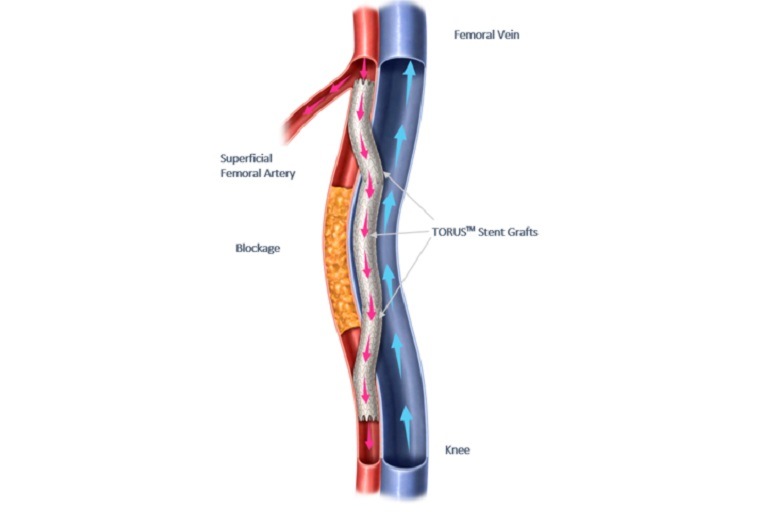 Three-year DETOUR2 results demonstrate sustained limb preservation in complex SFA disease