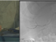 Fluidx Medical announces novel embolic gel used to treat large RCC tumour Fluidx Medical Technology