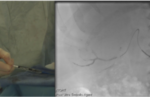 Fluidx Medical announces novel embolic gel used to treat large RCC tumour Fluidx Medical Technology
