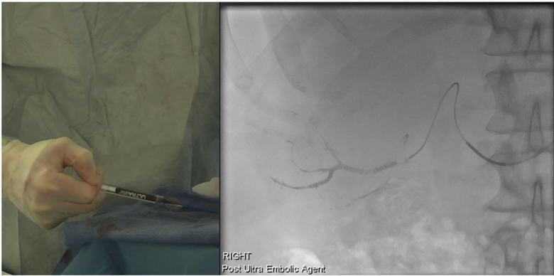 Fluidx Medical announces novel embolic gel used to treat large RCC tumour