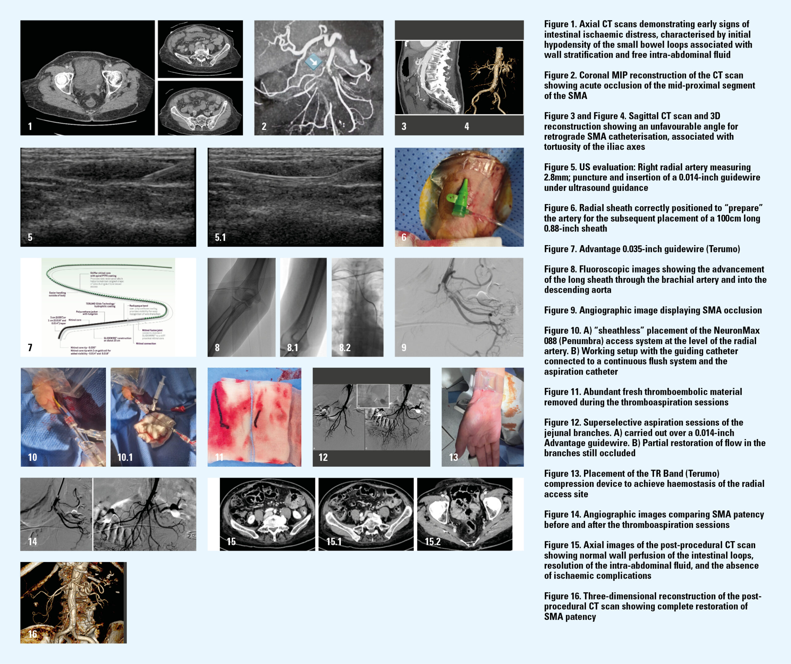 Protected: Radial access in complex emergency visceral interventions: lessons from two cases 