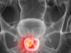 MRI-guided TULSA for localised prostate cancer provides “excellent” functional preservation, yet warrants “contextualisation” prostate cancer