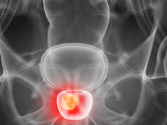 MRI-guided TULSA for localised prostate cancer provides “excellent” functional preservation, yet warrants “contextualisation” prostate cancer