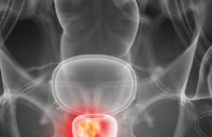 MRI-guided TULSA for localised prostate cancer provides “excellent” functional preservation, yet warrants “contextualisation” prostate cancer