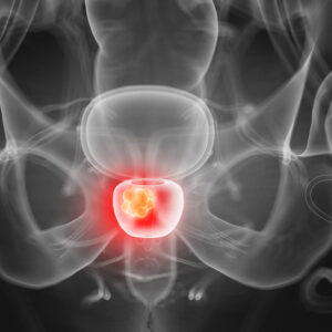 prostate cancer