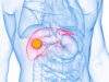 IR “most utilised” specialty for HCC, finds 25-year multidisciplinary analysis HCC