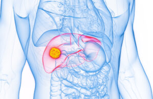 IR “most utilised” specialty for HCC, finds 25-year multidisciplinary analysis HCC