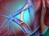 BD launches Liverty TIPS stent graft in the USA BD Liverty
