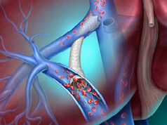 BD launches Liverty TIPS stent graft in the USA BD Liverty