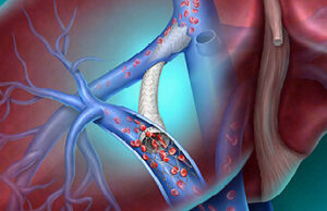 BD launches Liverty TIPS stent graft in the USA BD Liverty